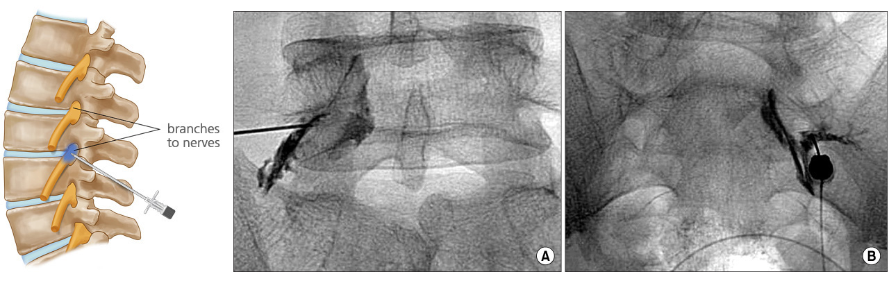 Nerve Block
